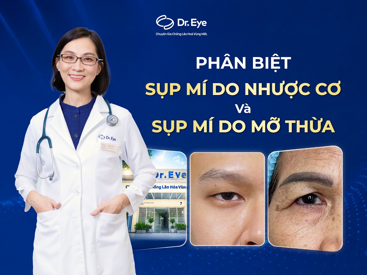 Phân biệt sụp mí do nhược cơ và sụp mí do mỡ thừa