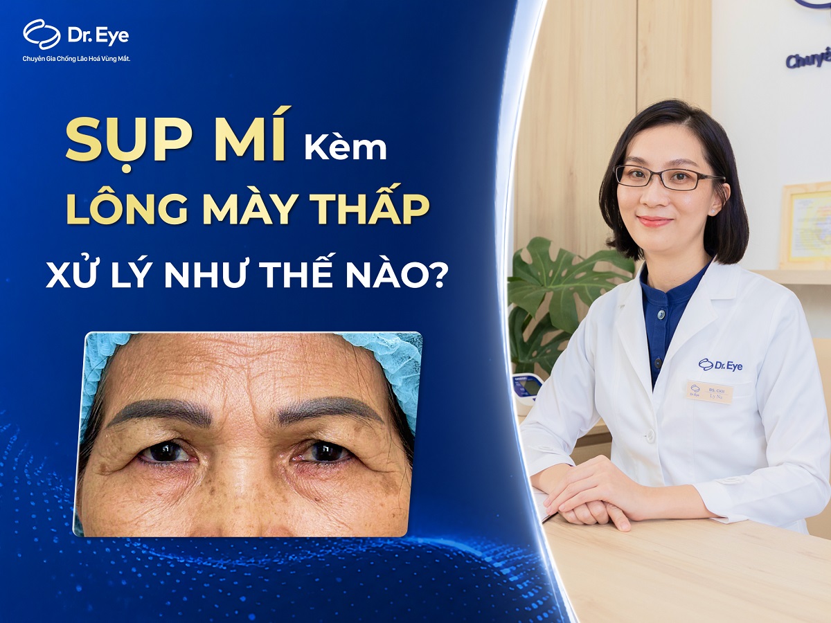 Sụp mí kèm lông mày thấp nên xử lý thế nào?