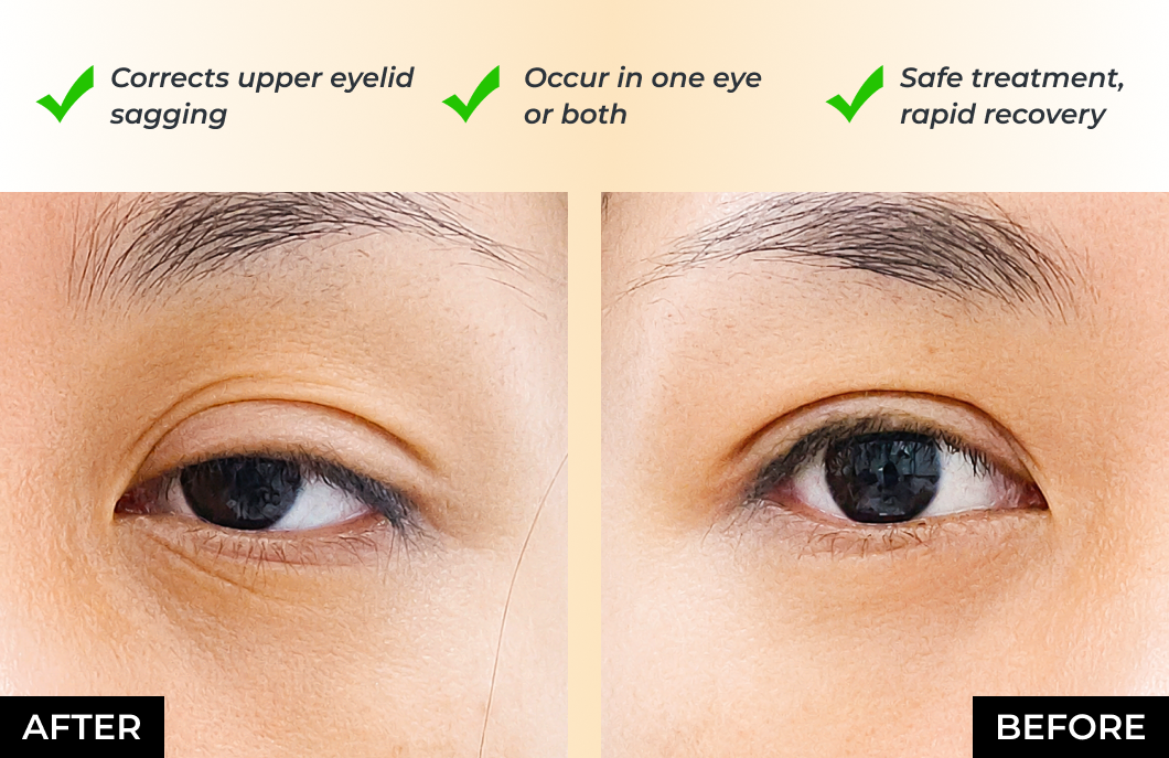 Ptosis Correction