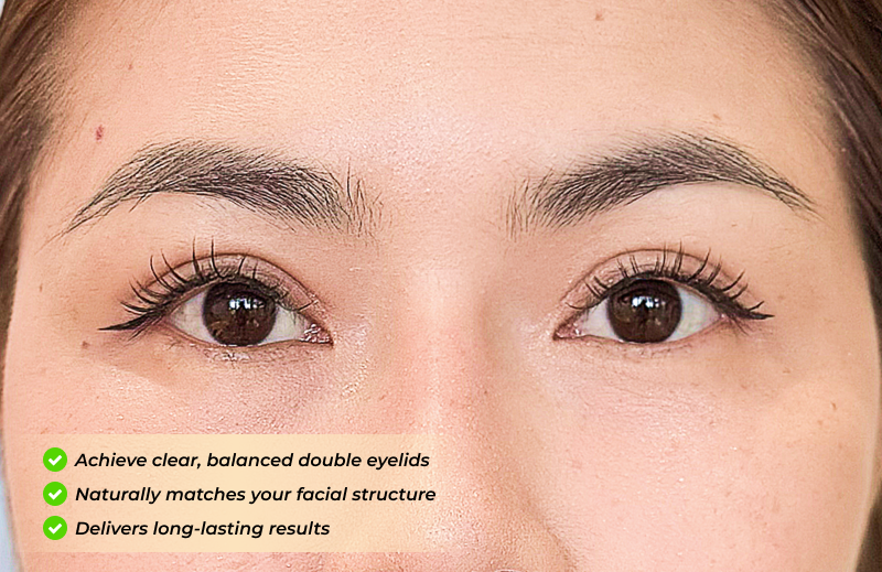 Solutions for uneven double eyelids, monolids, and hidden eyelid creases