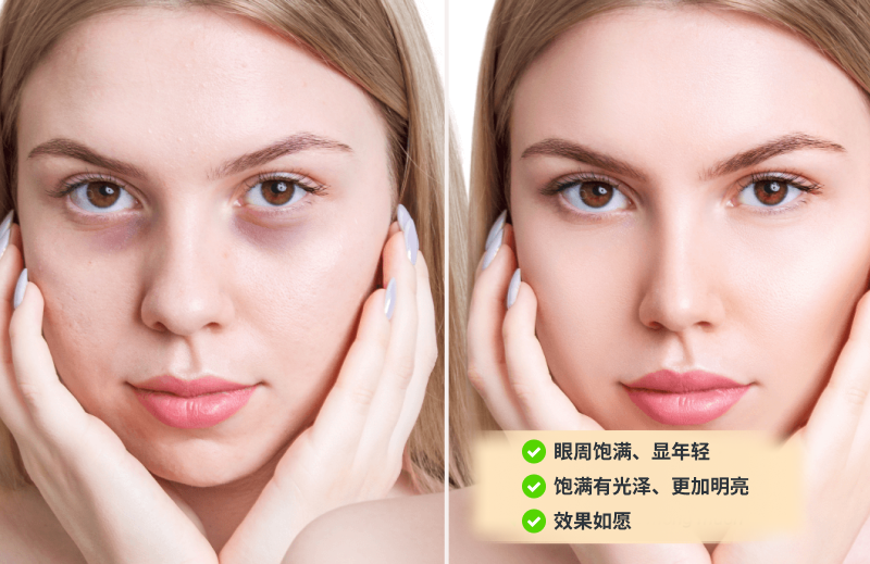 黑眼圈治疗