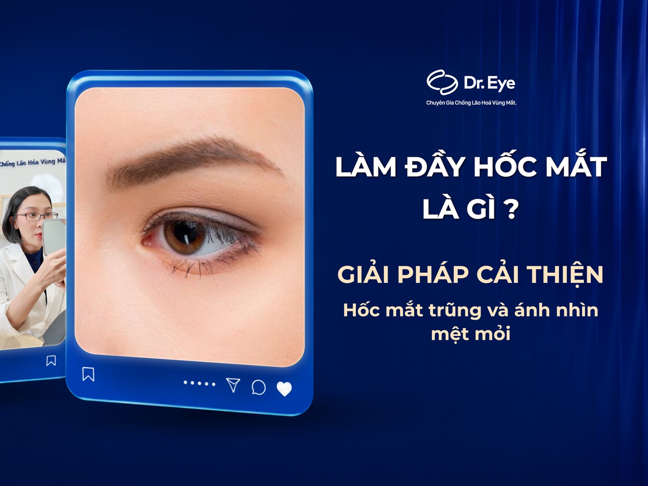 Làm đầy hốc mắt là gì? Giải pháp cải thiện hốc mắt trũng và ánh nhìn mệt mỏi