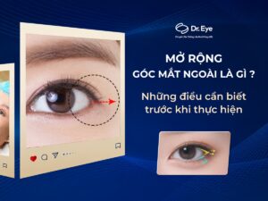 Mở rộng góc mắt ngoài là gì? Những điều cần biết trước khi thực hiện